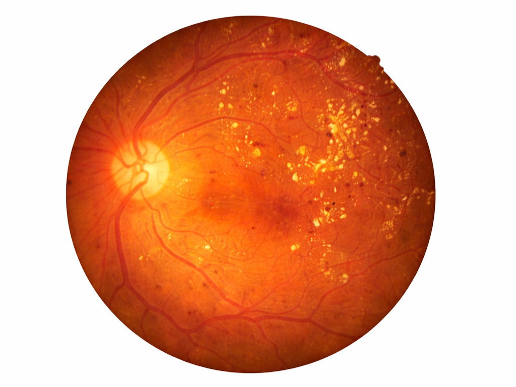 Fundus photograph showing diabetic retinopathy changes
