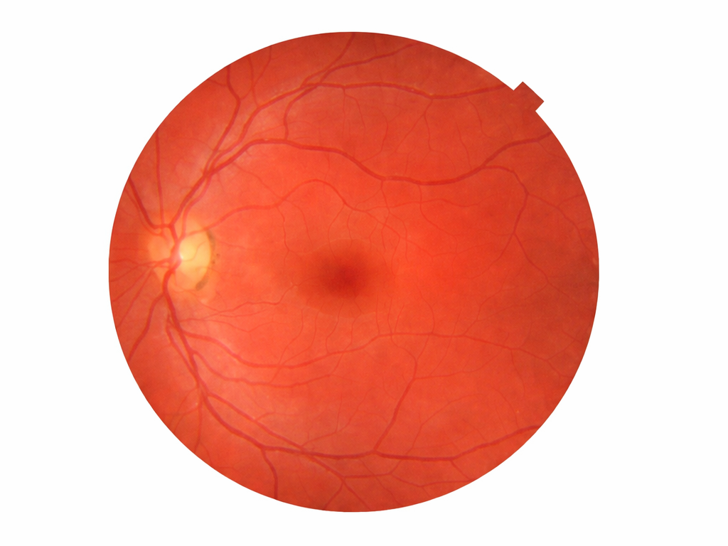 Fundus photograph of a healthy retina