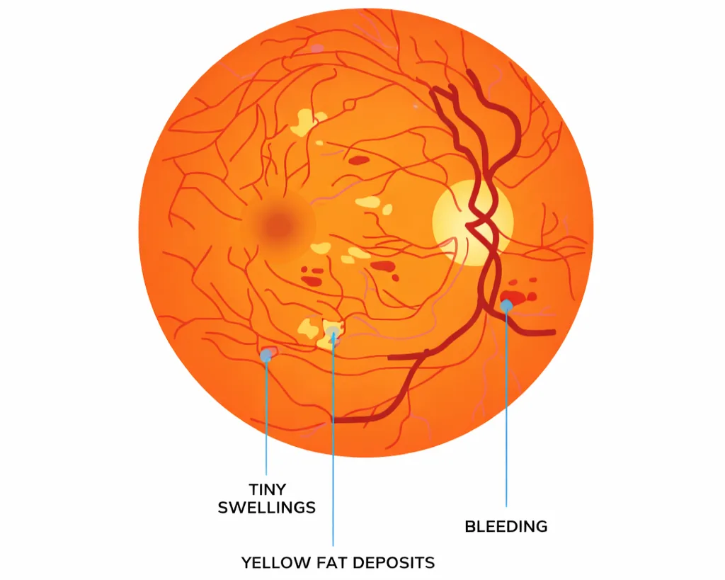 Non-proliferative diabetic retinopathy: retina illustration showing early changes